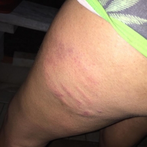 Marcas da agressão. (Foto: Portal Nova Santa Rosa)