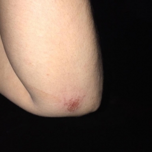 Marcas da agressão. (Fotos: Portal Nova Santa Rosa)