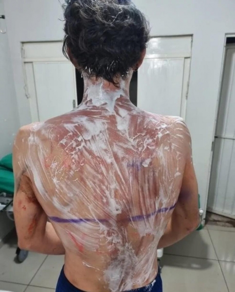 Estudantes da UFPR de Palotina são feridos em trote com creolina — Foto: Correio do Ar